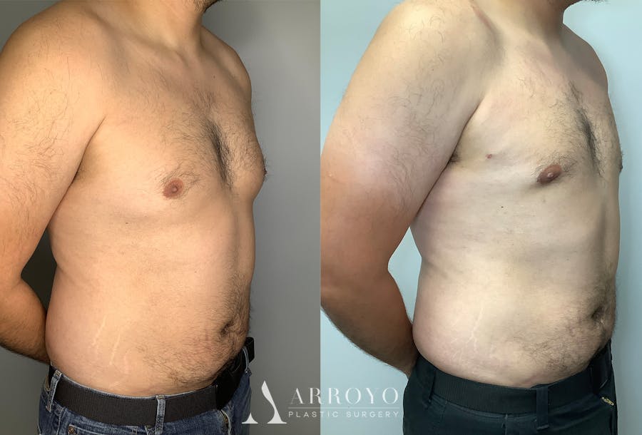 Gynecomastia Before & After Gallery - Patient 122931865 - Image 2