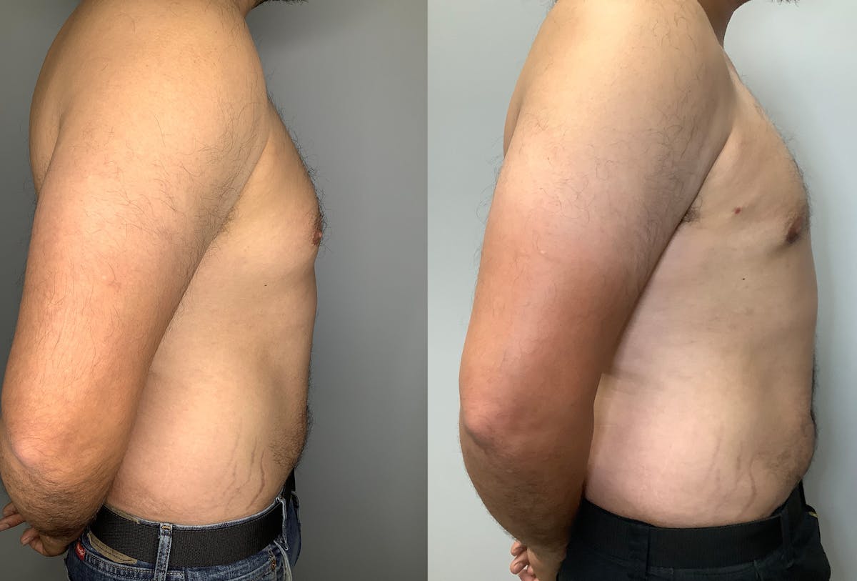 Gynecomastia Before & After Gallery - Patient 122931865 - Image 3