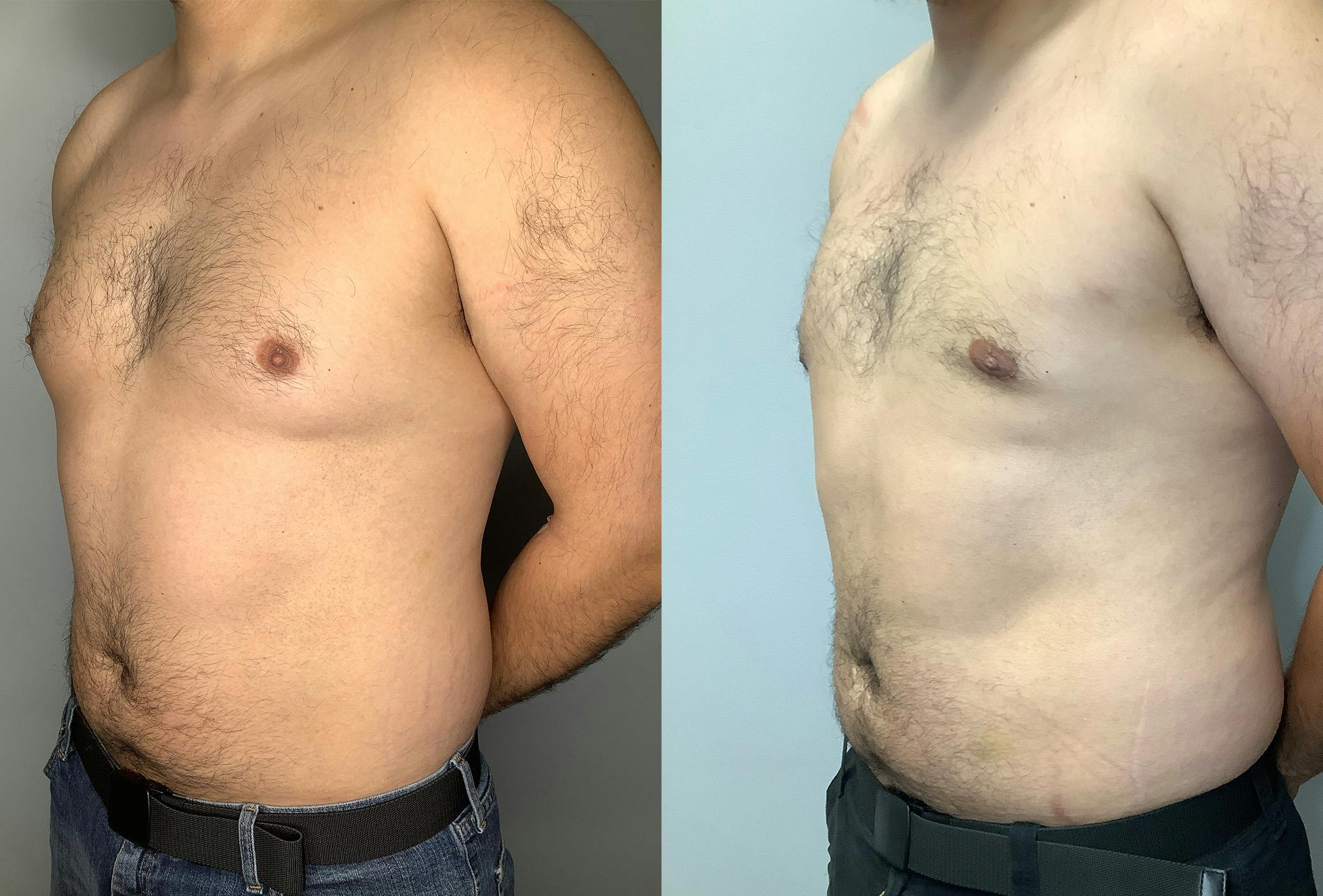 Gynecomastia Before & After Gallery - Patient 122931865 - Image 4