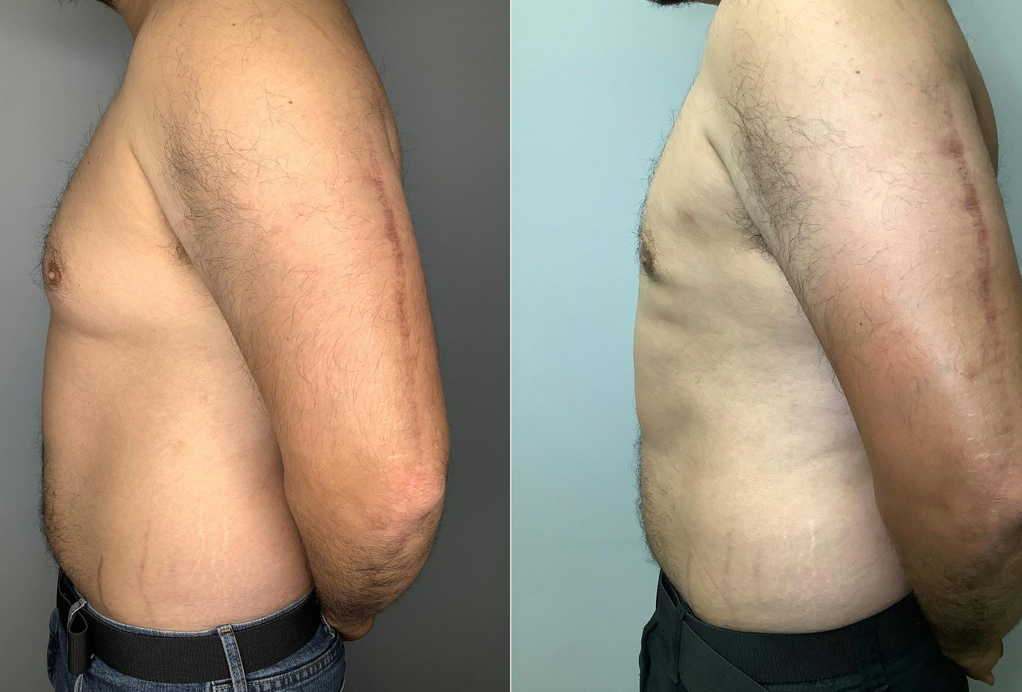 Gynecomastia Before & After Gallery - Patient 122931865 - Image 5