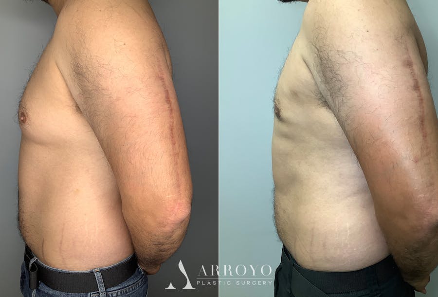 Gynecomastia Before & After Gallery - Patient 122931865 - Image 5
