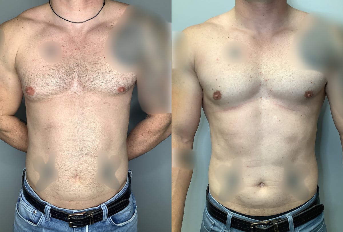 Gynecomastia Before & After Gallery - Patient 122931909 - Image 1