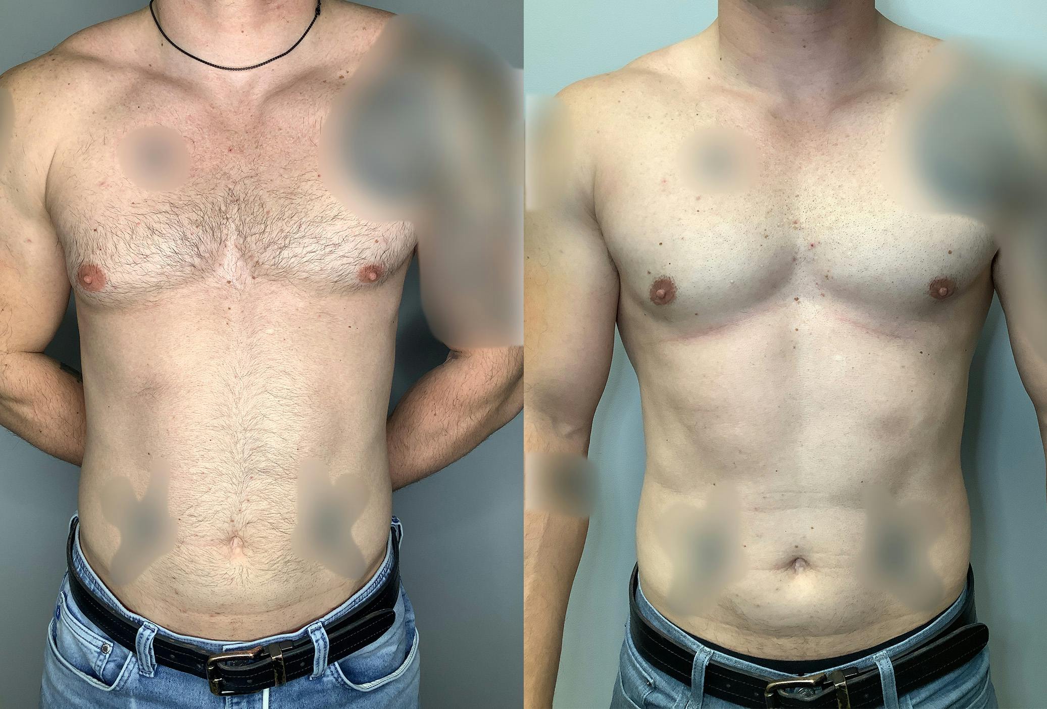 Gynecomastia Before & After Gallery - Patient 122931909 - Image 1