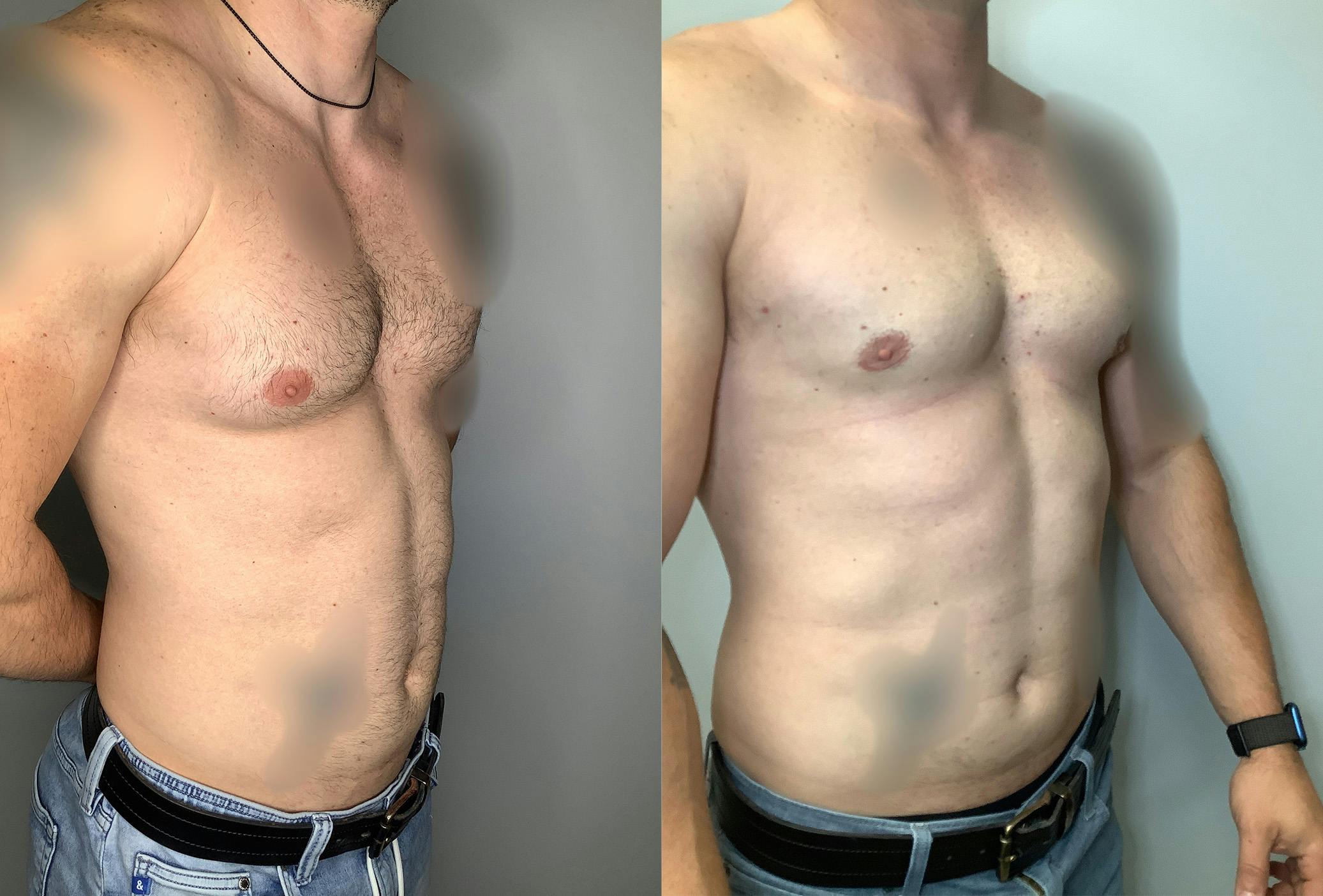 Gynecomastia Before & After Gallery - Patient 122931909 - Image 2