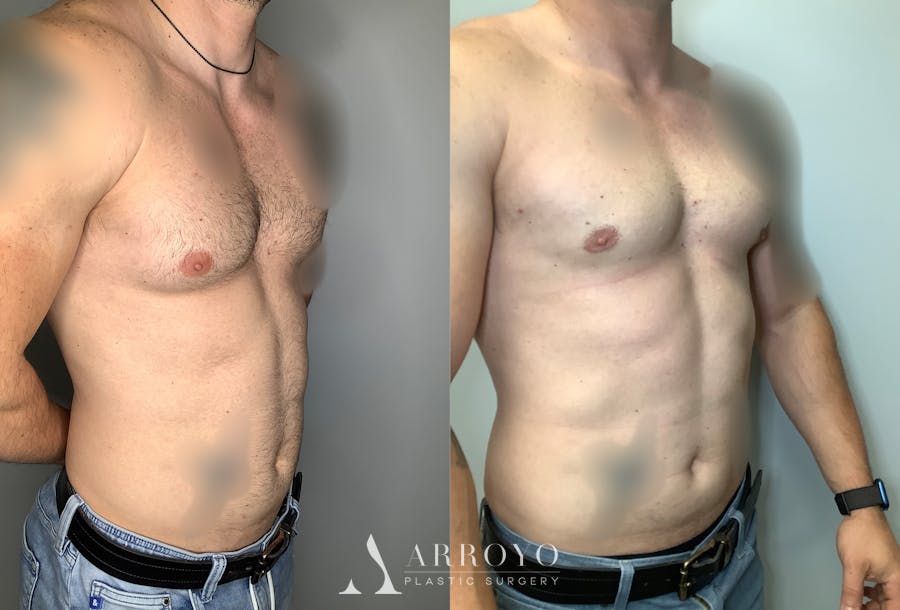 Gynecomastia Before & After Gallery - Patient 122931909 - Image 2