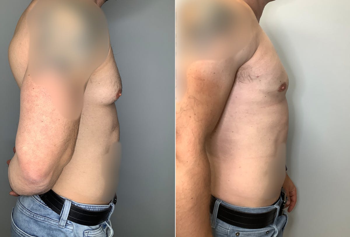 Gynecomastia Before & After Gallery - Patient 122931909 - Image 3