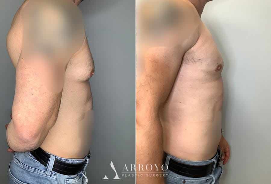 Gynecomastia Before & After Gallery - Patient 122931909 - Image 3