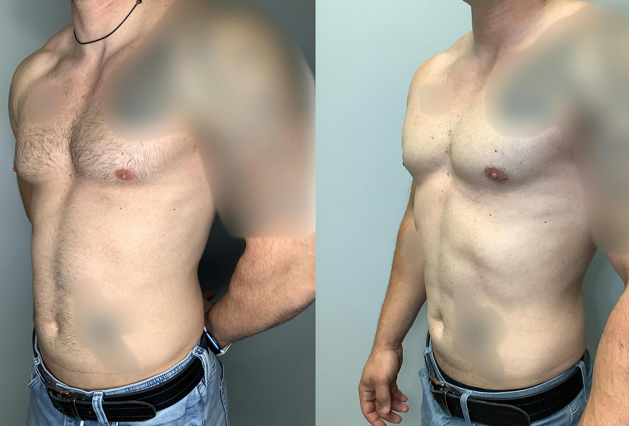 Gynecomastia Before & After Gallery - Patient 122931909 - Image 4