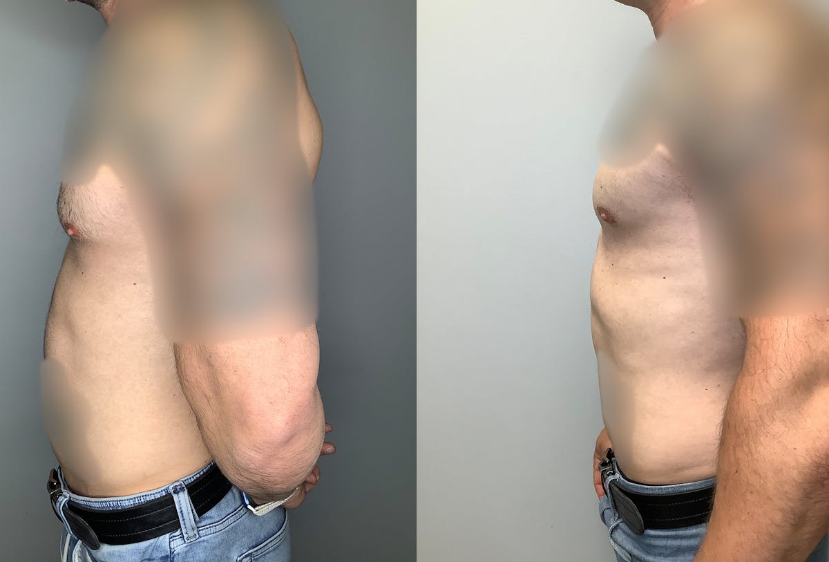 Gynecomastia Before & After Gallery - Patient 122931909 - Image 5