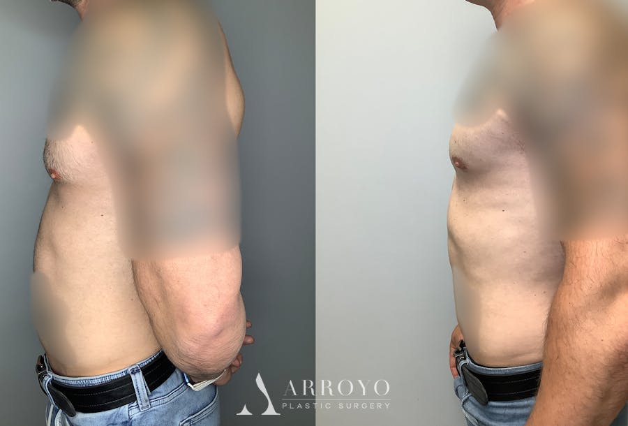 Gynecomastia Before & After Gallery - Patient 122931909 - Image 5