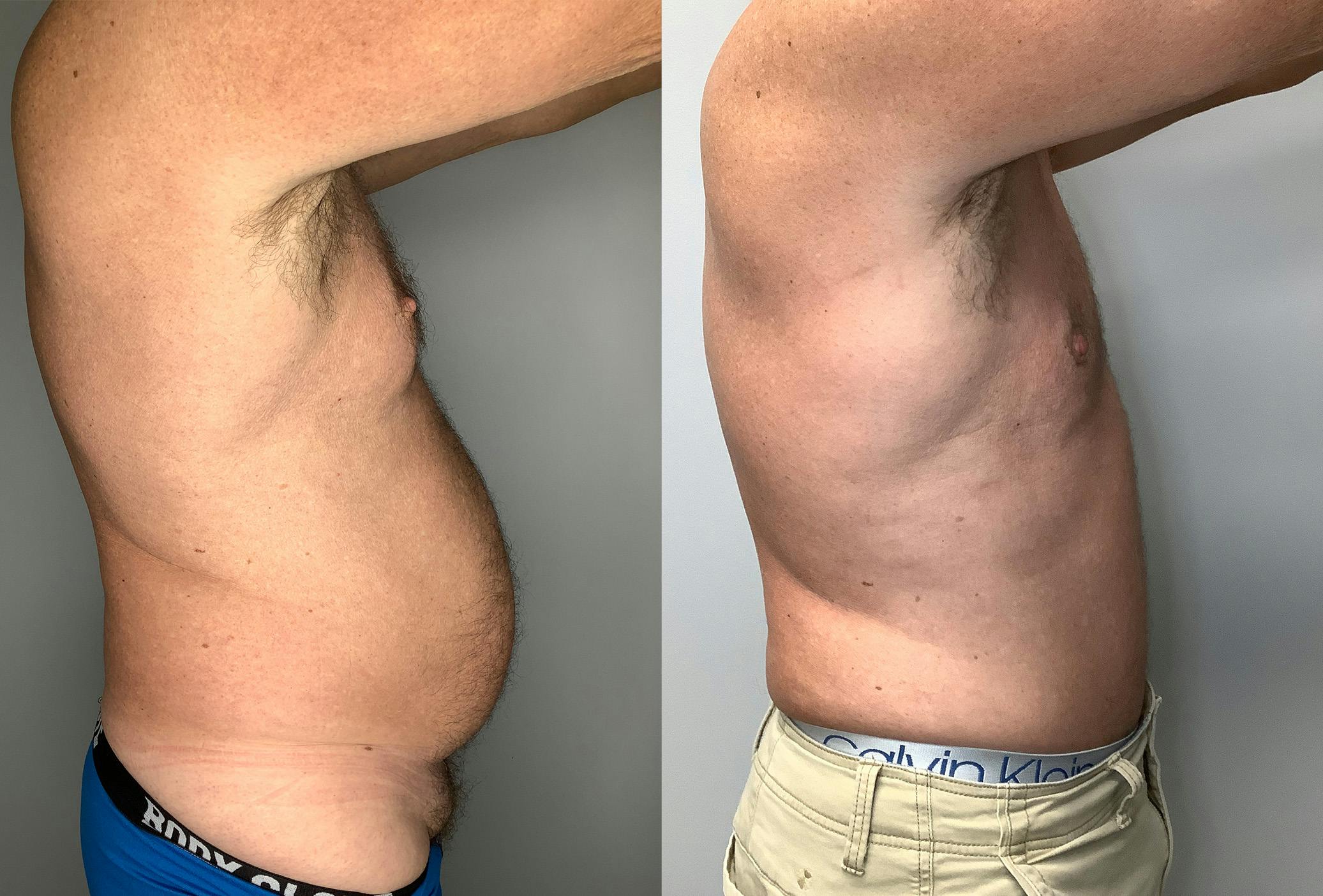 Gynecomastia Before & After Gallery - Patient 122931910 - Image 1