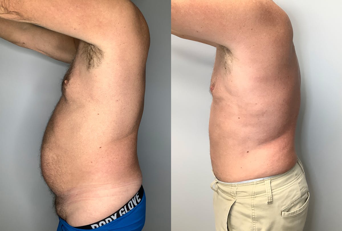 Gynecomastia Before & After Gallery - Patient 122931910 - Image 2