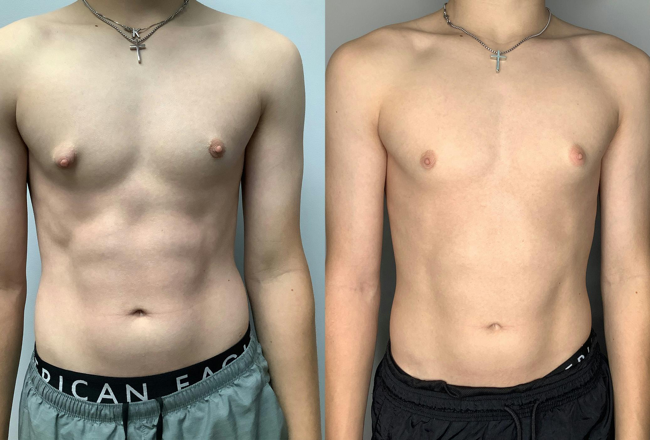 Before and After Male Breast Reduction in Houston - 03
