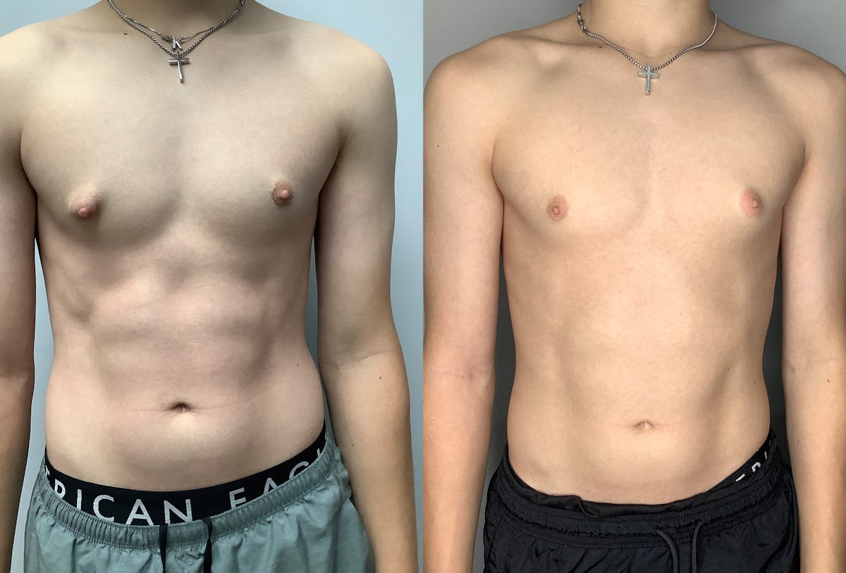Gynecomastia Before & After Gallery - Patient 122931911 - Image 1