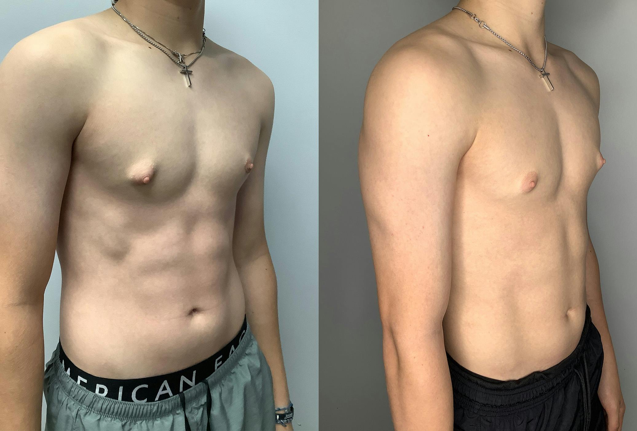 Gynecomastia Before & After Gallery - Patient 122931911 - Image 2