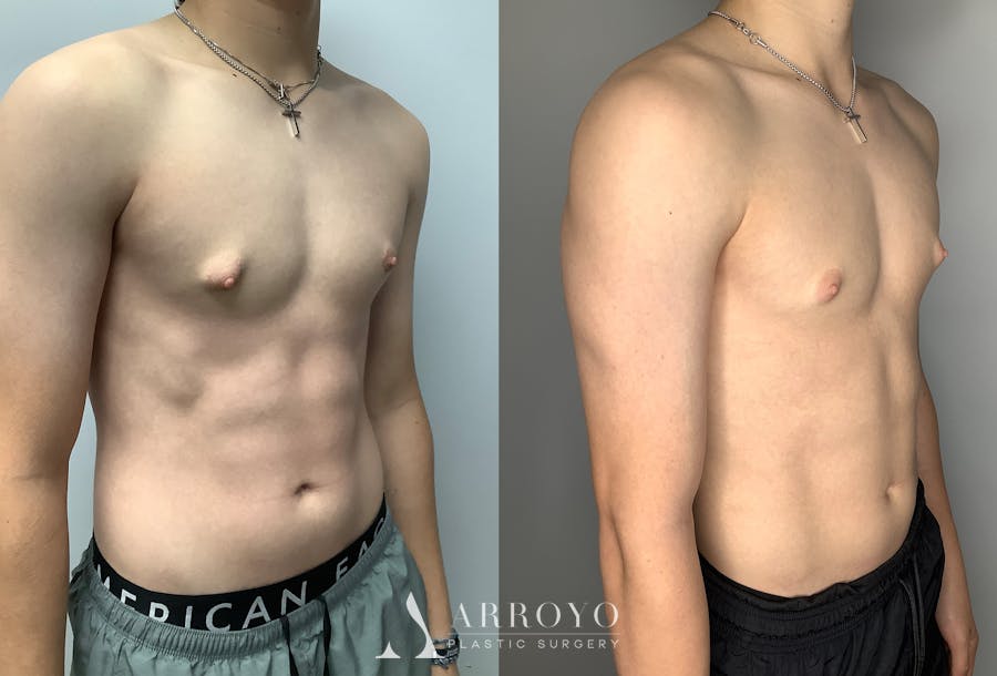 Gynecomastia Before & After Gallery - Patient 122931911 - Image 2