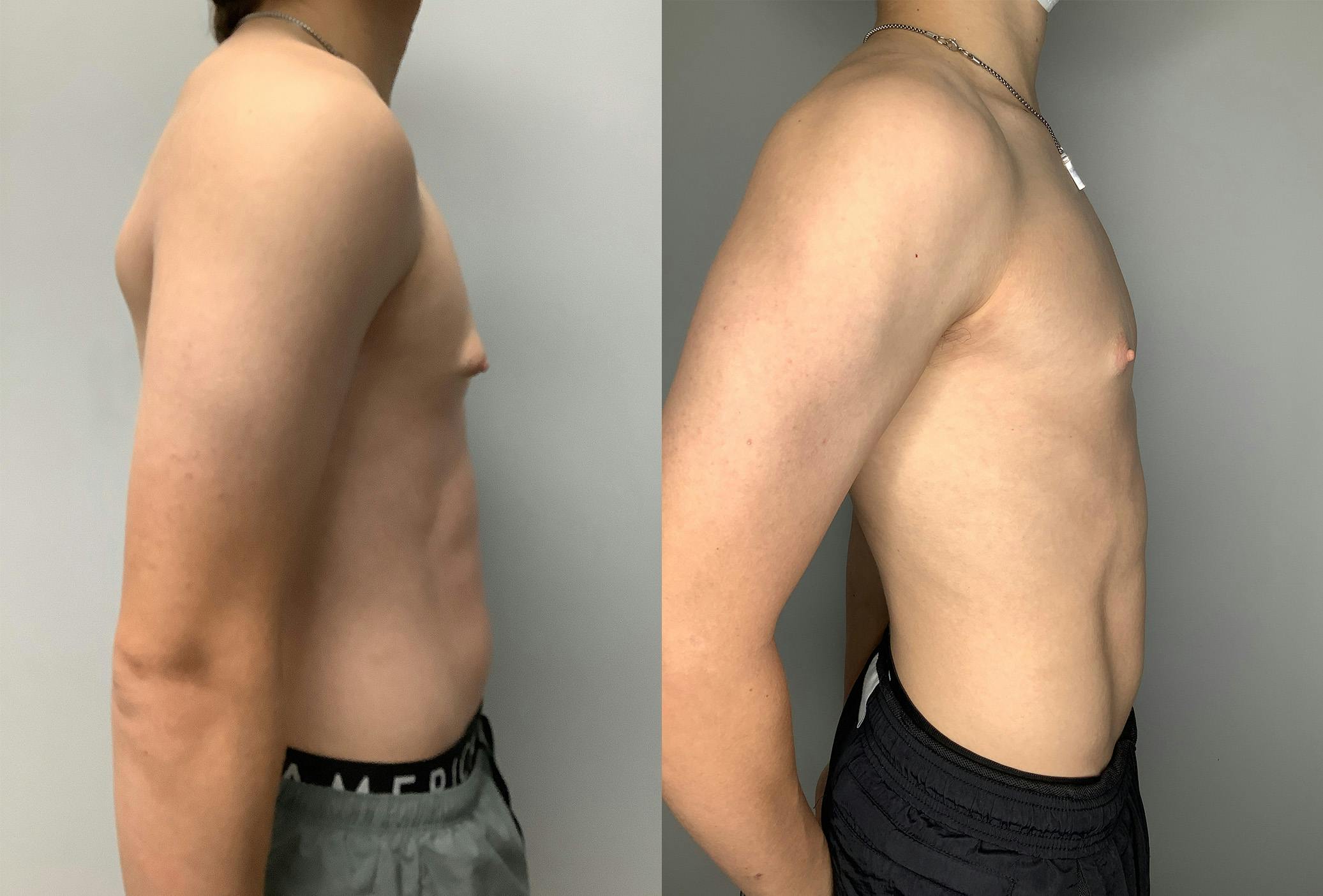 Gynecomastia Before & After Gallery - Patient 122931911 - Image 3