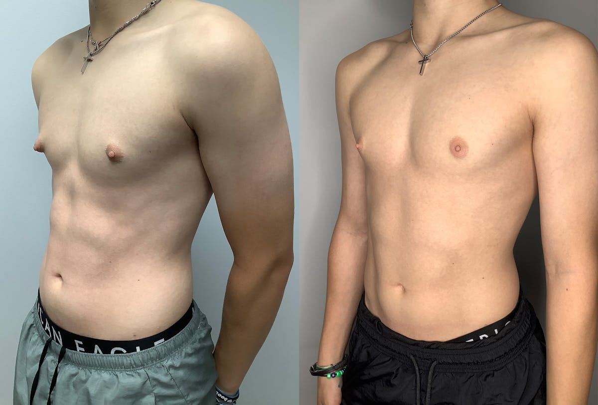 Gynecomastia Before & After Gallery - Patient 122931911 - Image 4