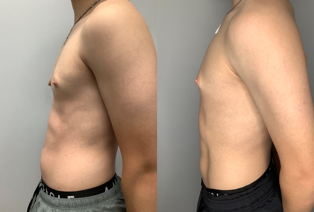 Gynecomastia Before & After Gallery - Patient 122931911 - Image 5
