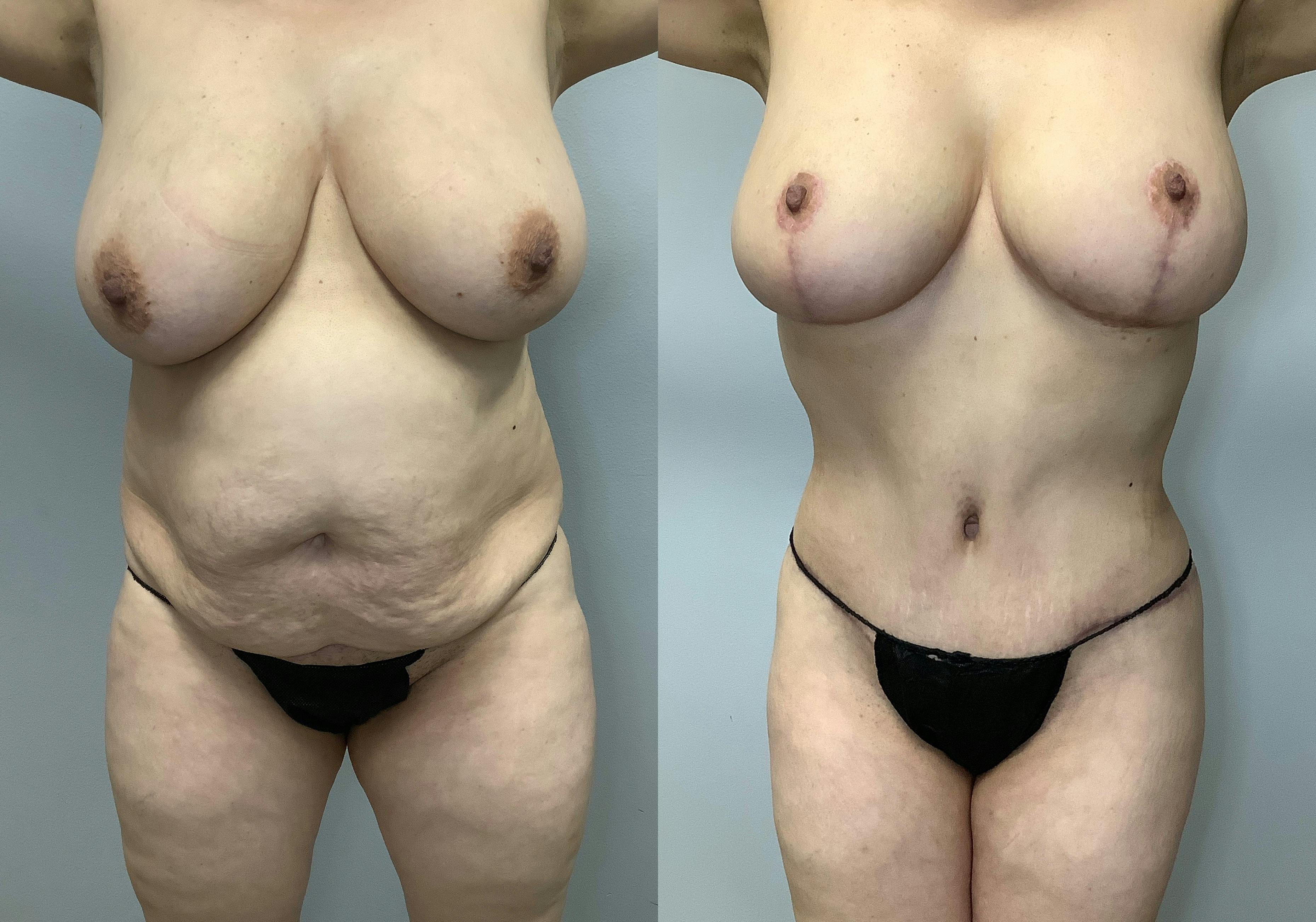 Before and After a Breast Lift in Houston