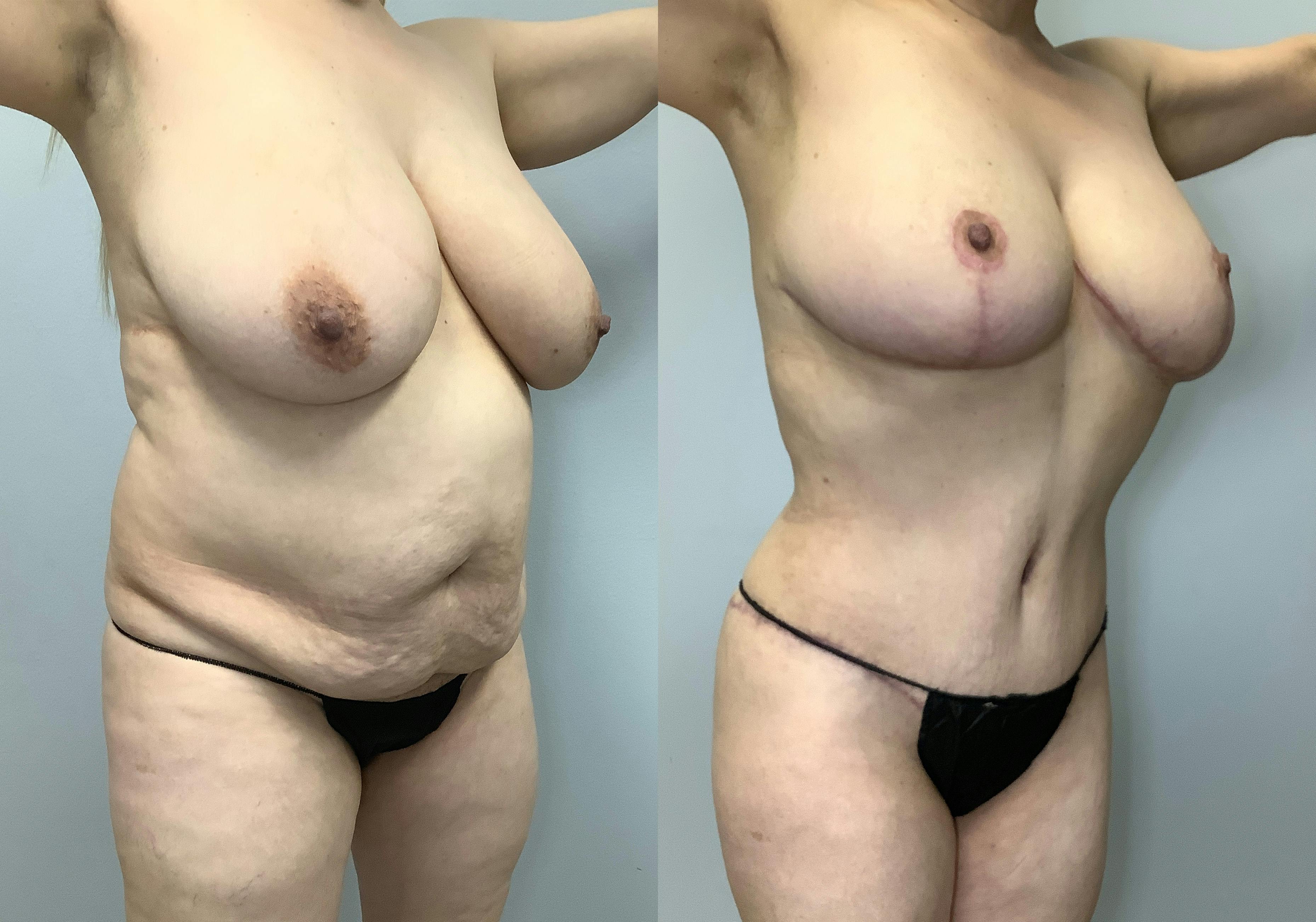 before and after of a Houston tummy tuck patient - 05