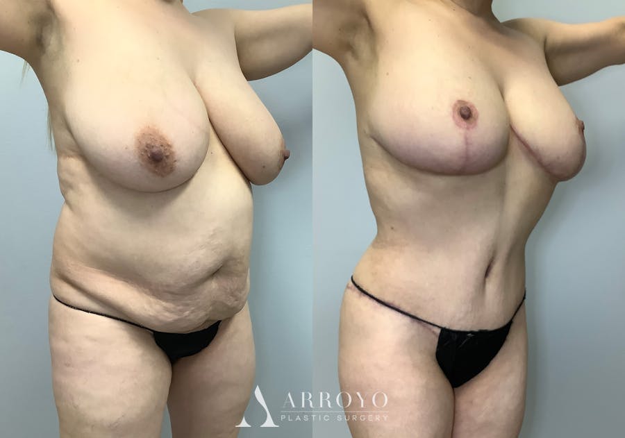 Tummy Tuck Before & After Gallery - Patient 128766431 - Image 2