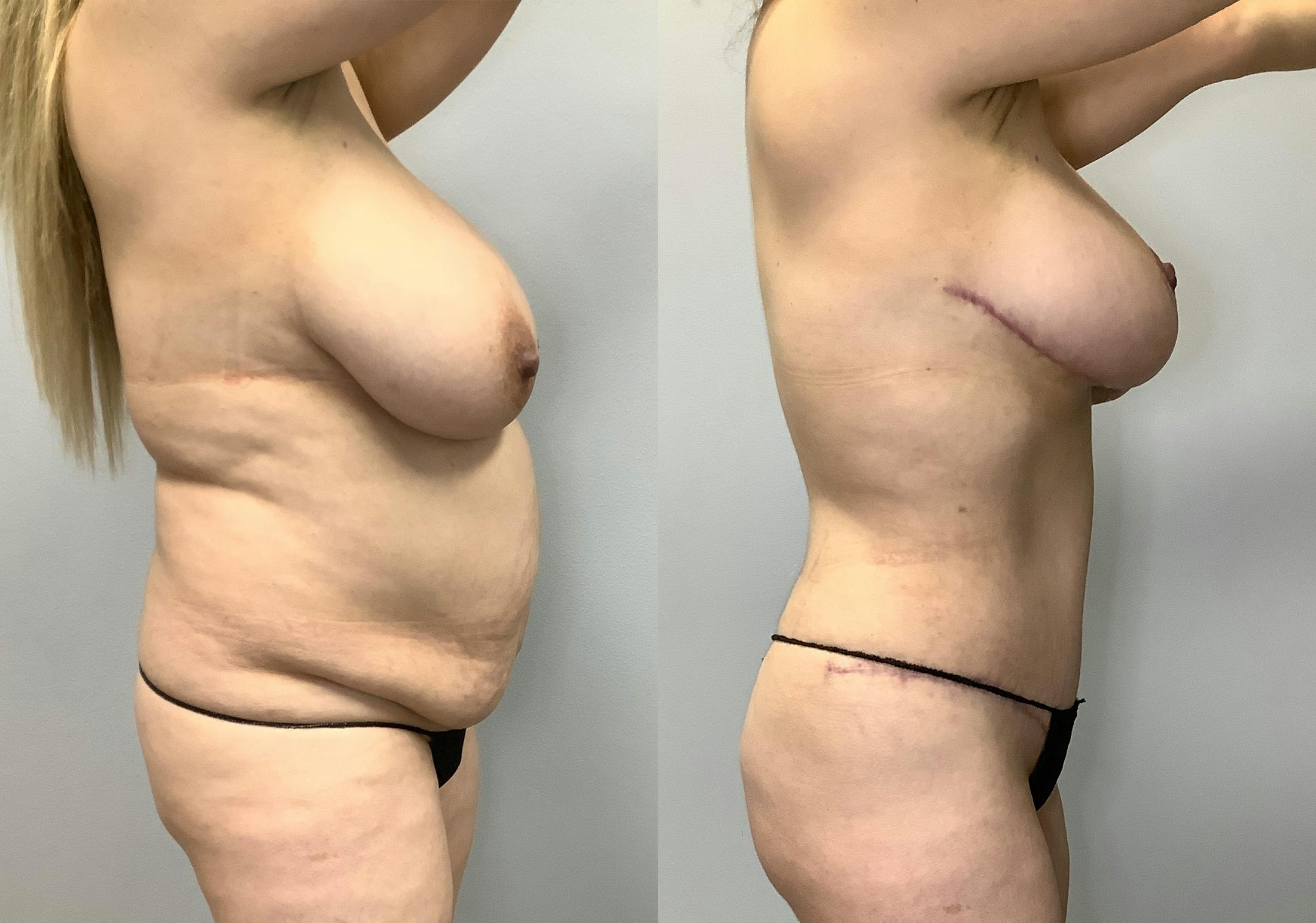 Breast Lift Before & After Gallery - Patient 128766435 - Image 3