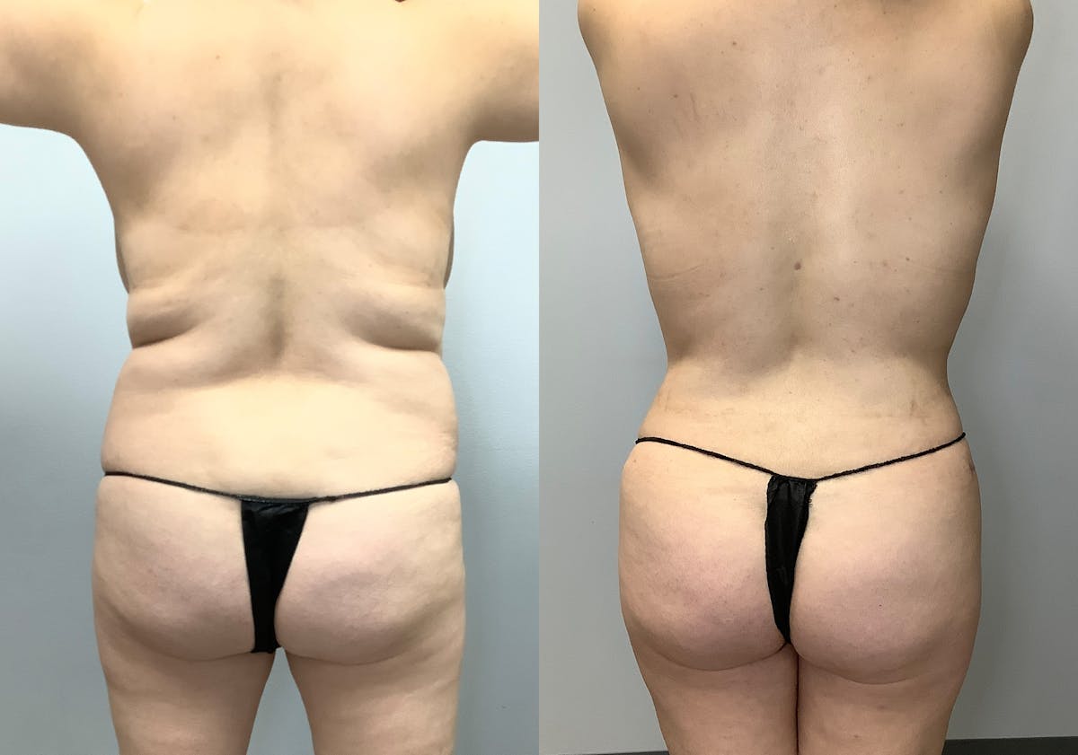 Liposuction Before & After Gallery - Patient 128766433 - Image 4