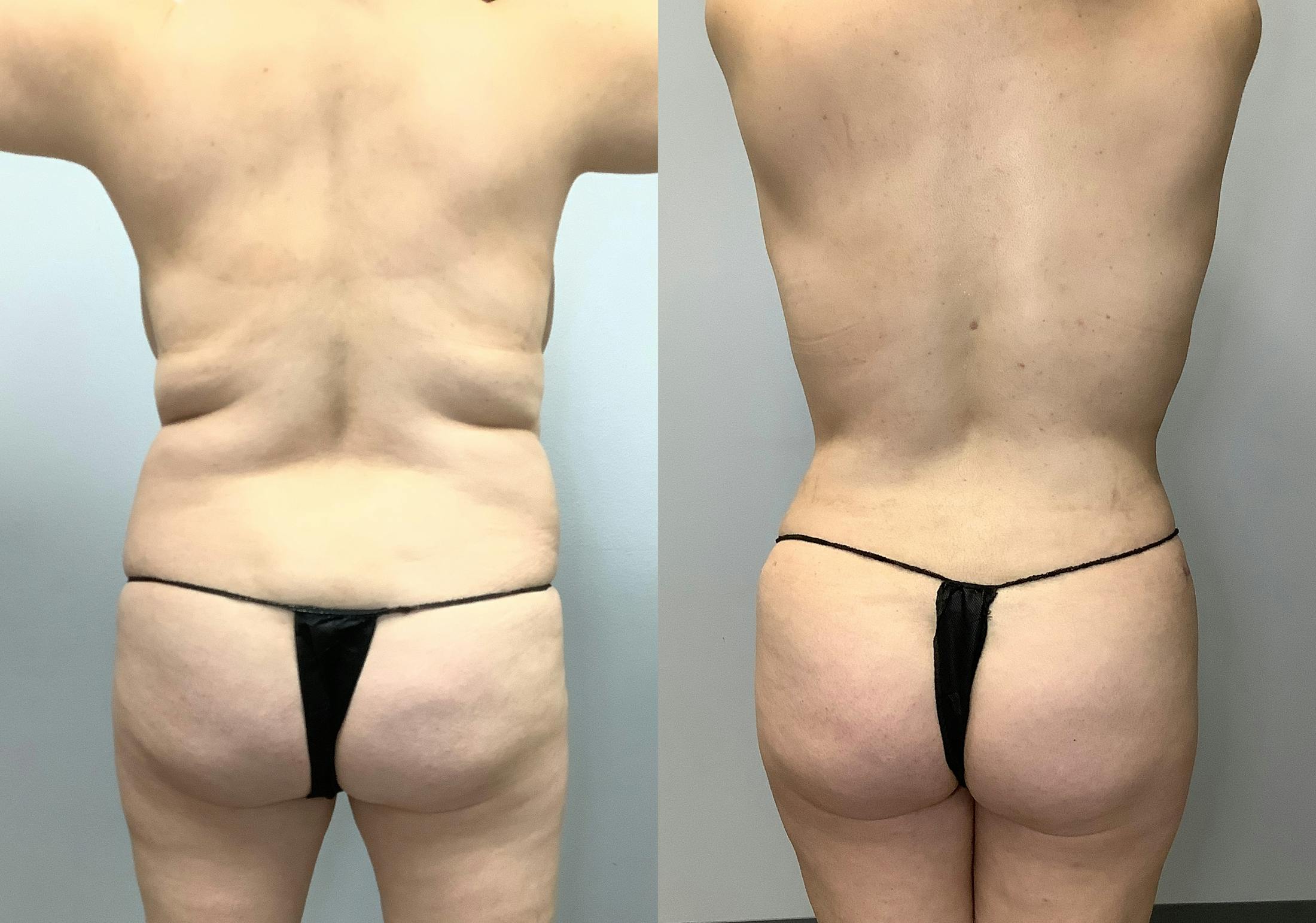Tummy Tuck Before & After Gallery - Patient 128766431 - Image 4