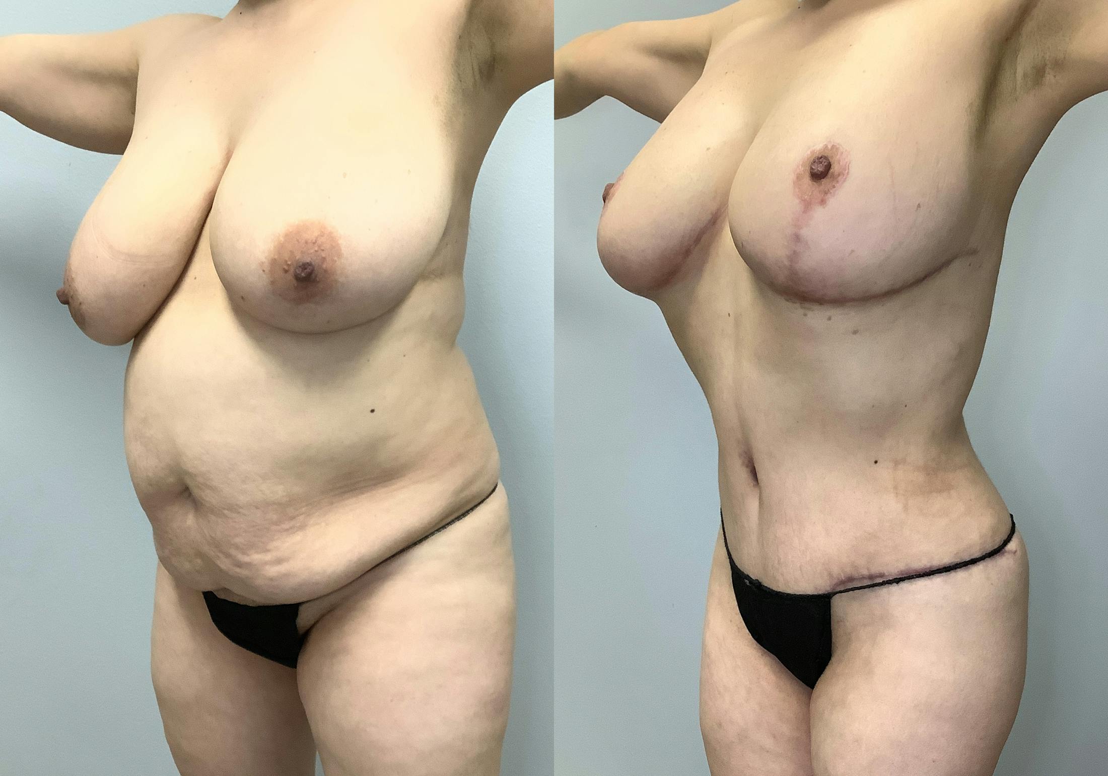 Tummy Tuck Before & After Gallery - Patient 128766431 - Image 5