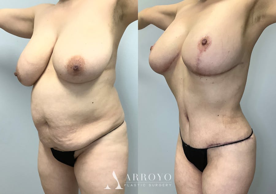 Tummy Tuck Before & After Gallery - Patient 128766431 - Image 5