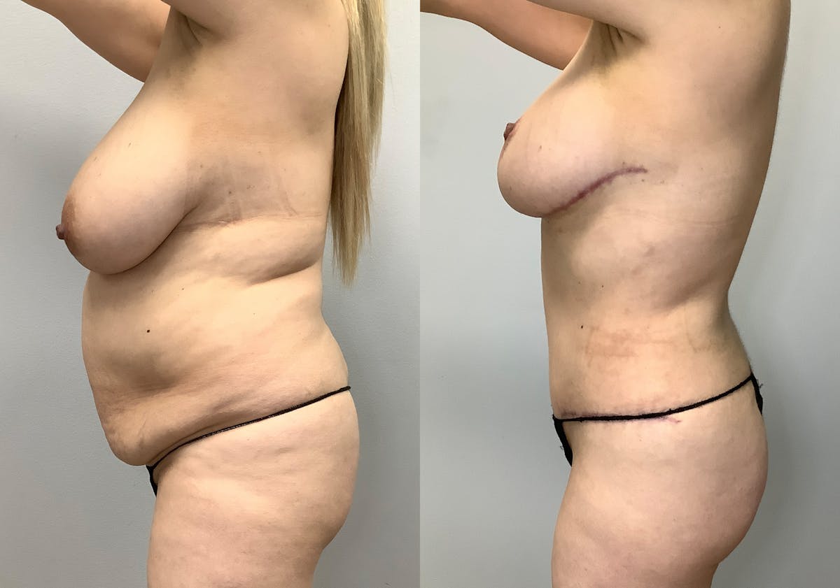 Breast Lift Before & After Gallery - Patient 128766435 - Image 6