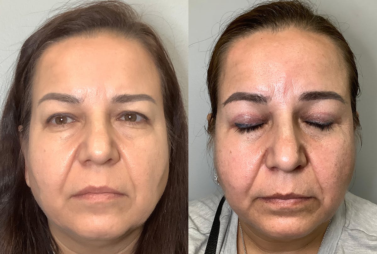 Blepharoplasty Before & After Gallery - Patient 141595076 - Image 1