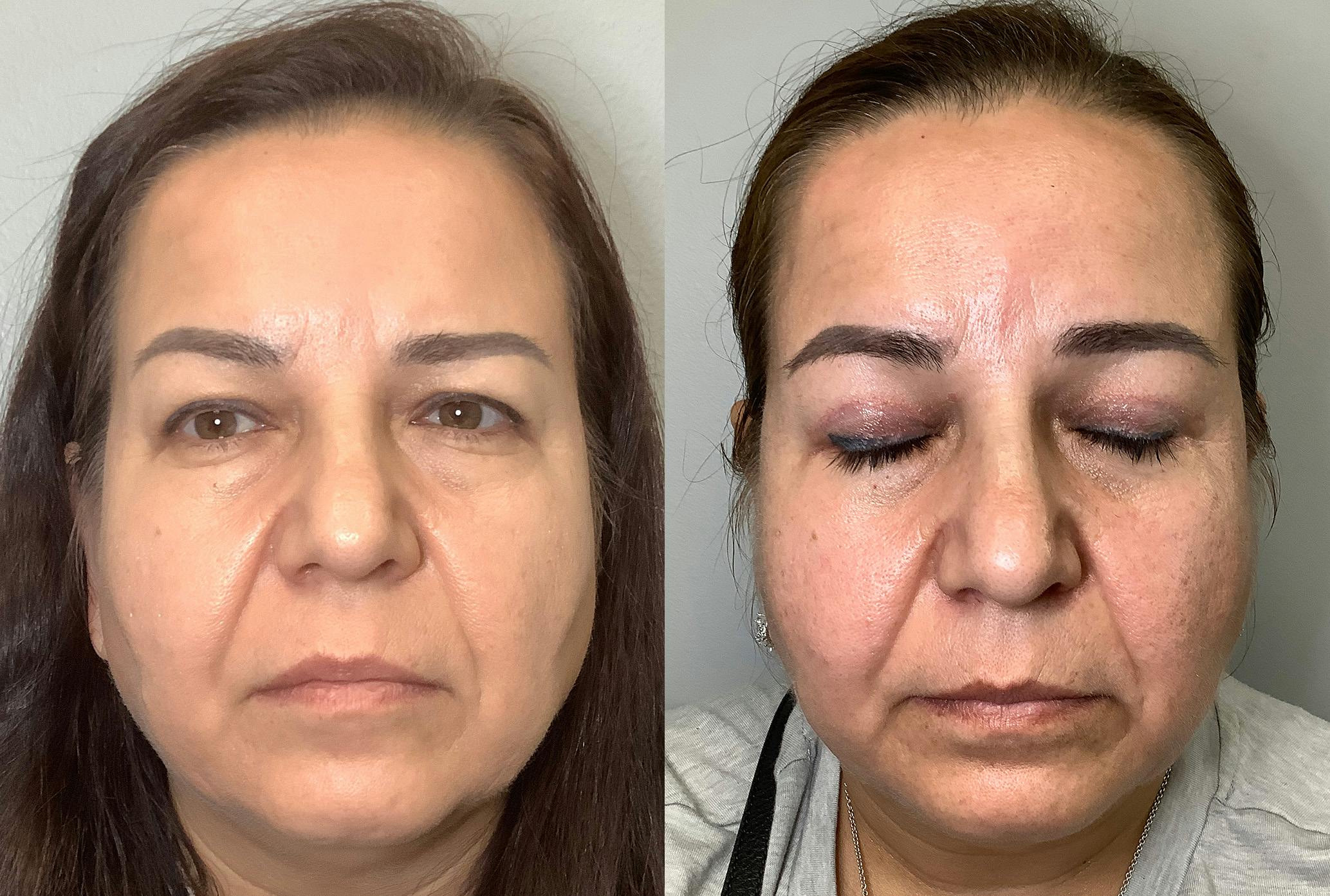 Blepharoplasty Before & After Gallery - Patient 141595076 - Image 1
