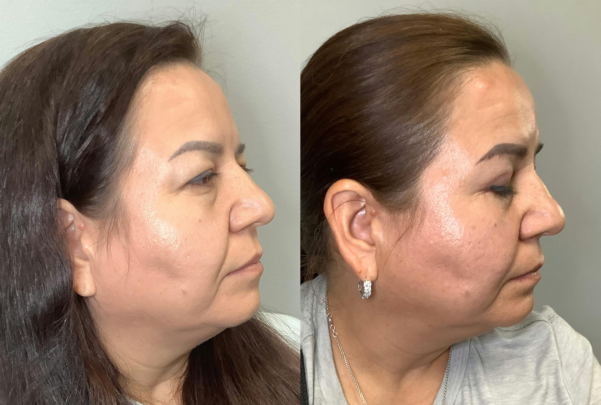 Blepharoplasty Before & After Gallery - Patient 141595076 - Image 2