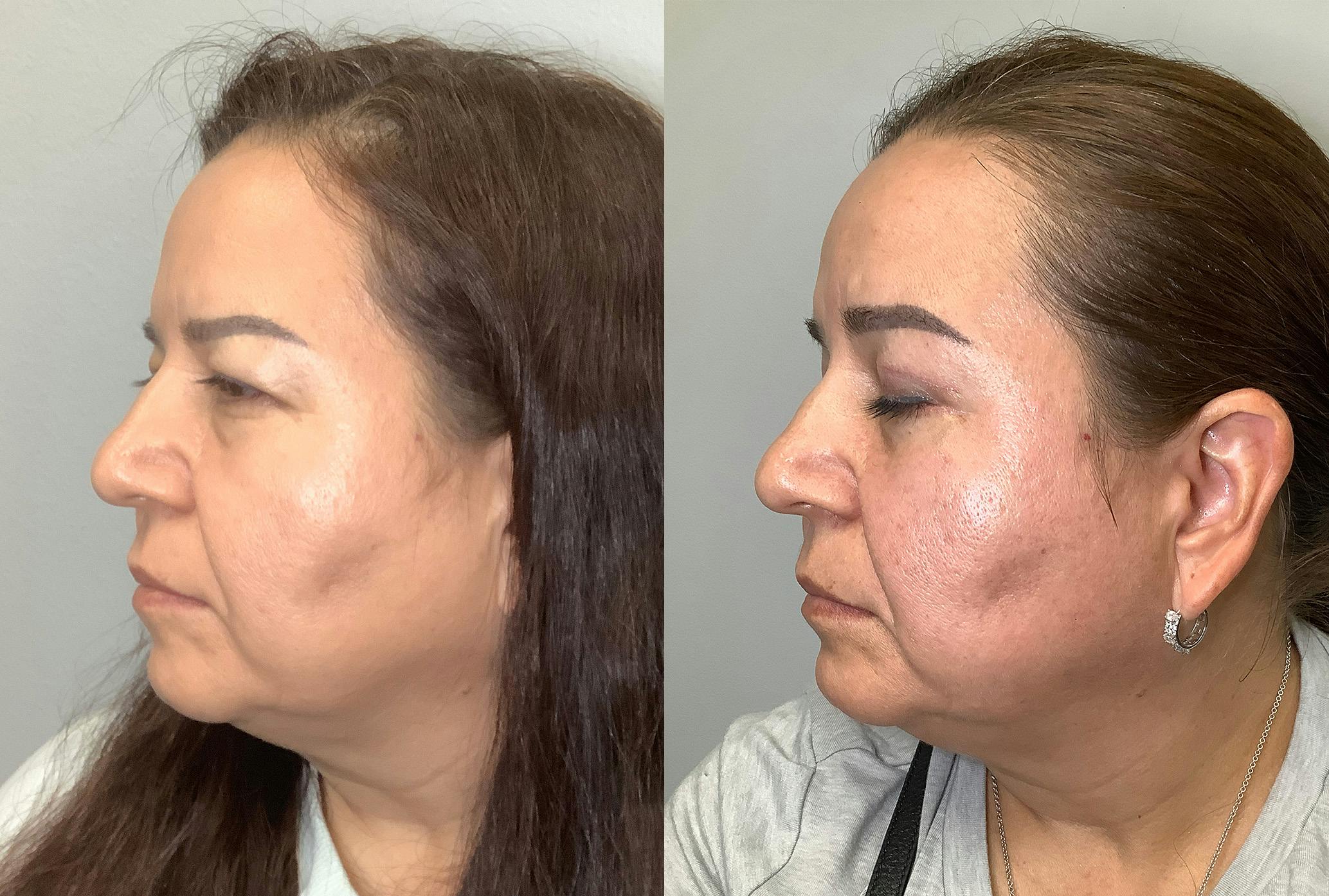 Blepharoplasty Before & After Gallery - Patient 141595076 - Image 3