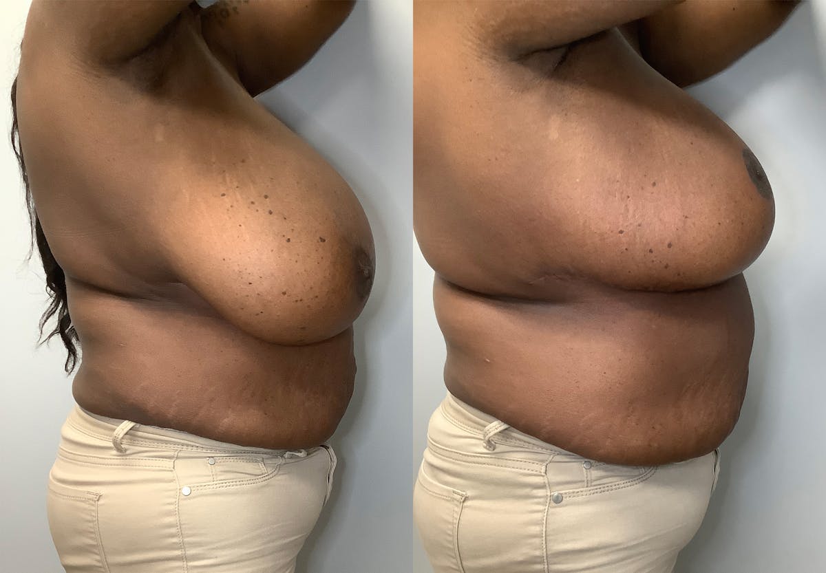 Breast Reduction Before & After Gallery - Patient 141595089 - Image 3
