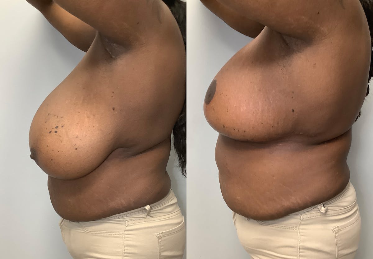 Breast Lift Before & After Gallery - Patient 141595090 - Image 5