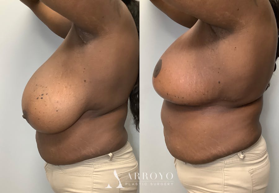 Breast Lift Before & After Gallery - Patient 141595090 - Image 5