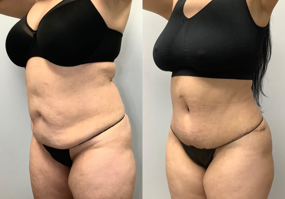 Brazilian Butt Lift Before & After Gallery - Patient 141595120 - Image 1