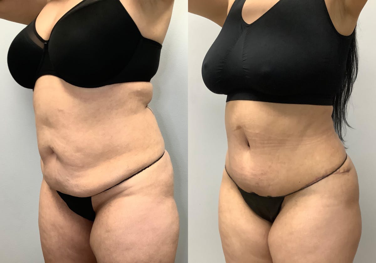 Tummy Tuck Before & After Gallery - Patient 141595112 - Image 1