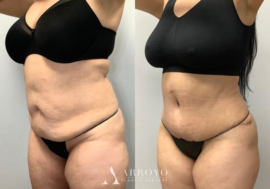 Brazilian Butt Lift Before & After Gallery - Patient 141595120 - Image 1