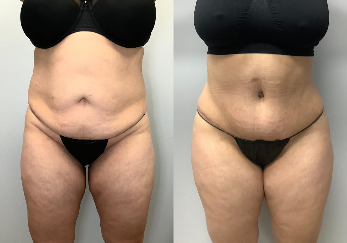 Brazilian Butt Lift Before & After Gallery - Patient 141595120 - Image 2