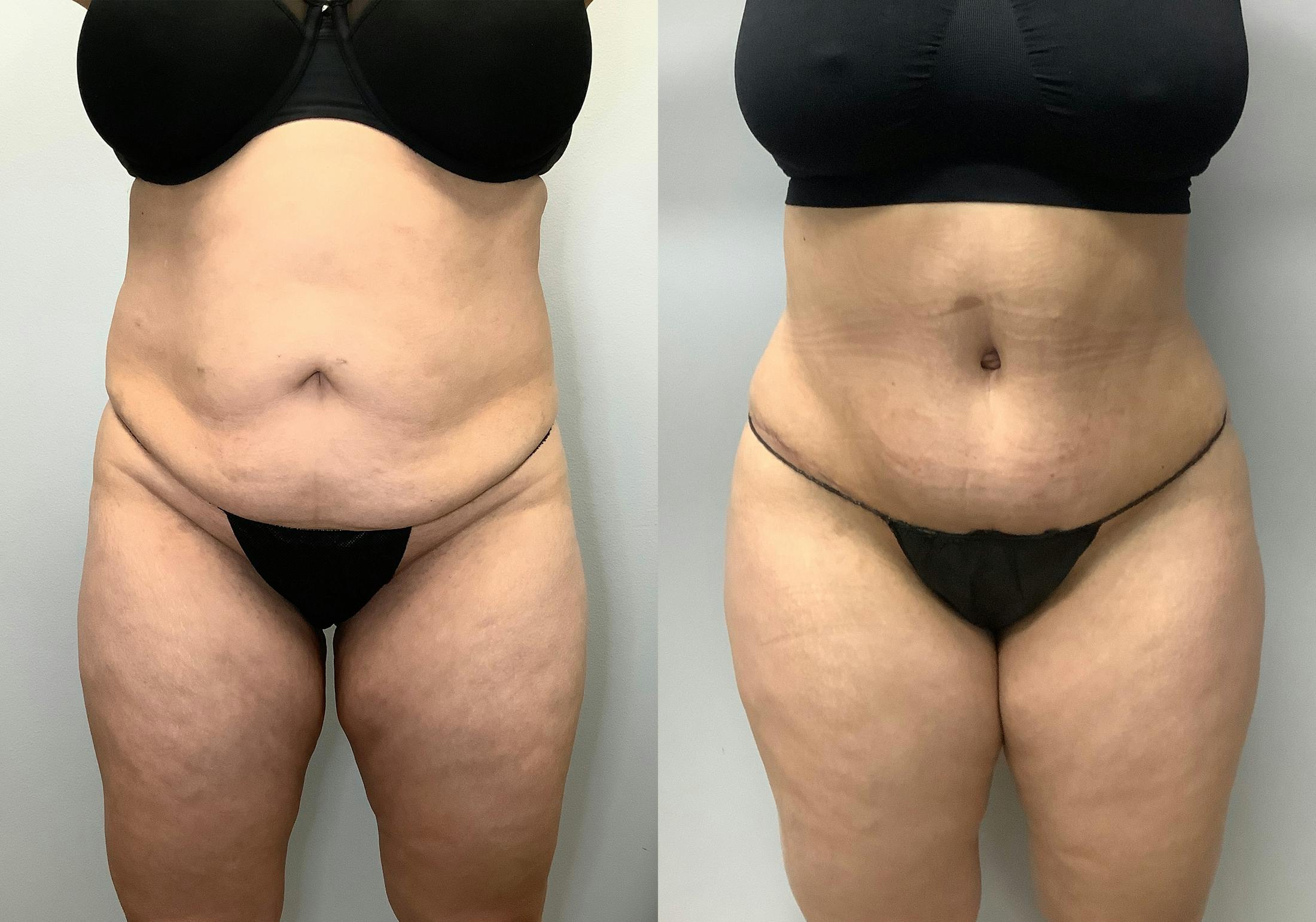 Liposuction Before & After Gallery - Patient 141595118 - Image 2