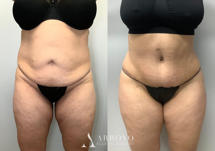 Brazilian Butt Lift Before & After Gallery - Patient 141595120 - Image 2