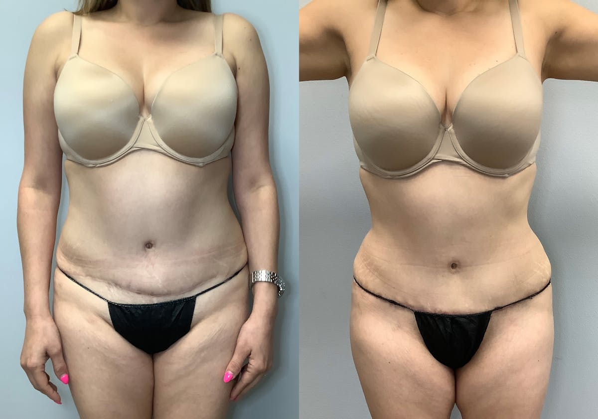 Liposuction Before & After Gallery - Patient 141595132 - Image 1