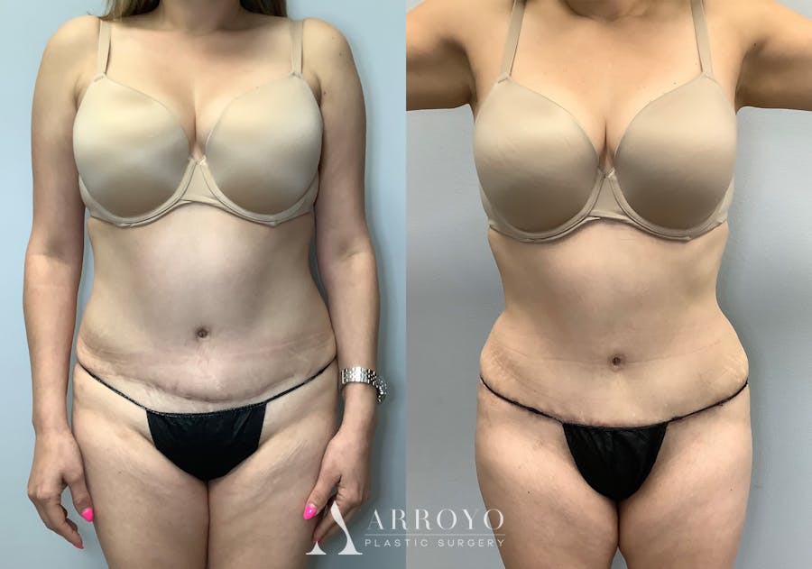 Tummy Tuck Before & After Gallery - Patient 141595133 - Image 1