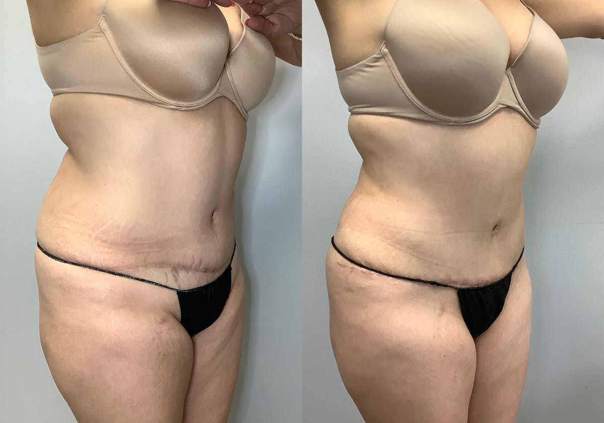 Liposuction Before & After Gallery - Patient 141595132 - Image 2