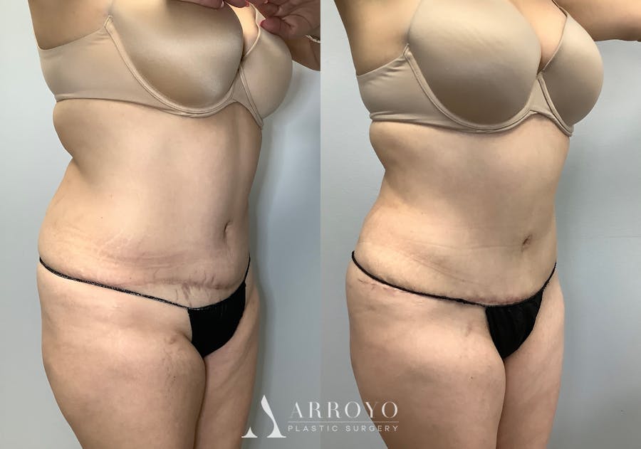 Tummy Tuck Before & After Gallery - Patient 141595133 - Image 2