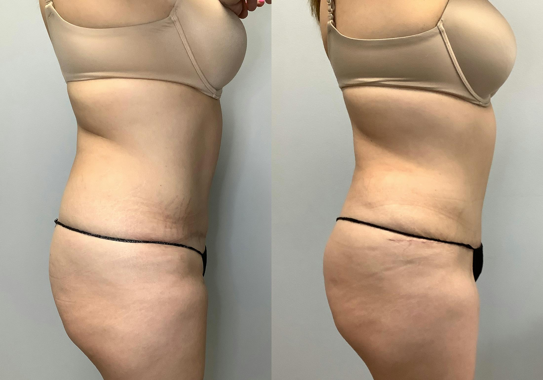 Tummy Tuck Before & After Gallery - Patient 141595133 - Image 3